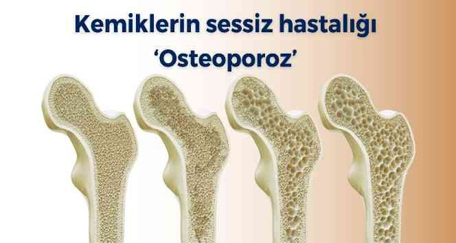 Kemiklerin sessiz hastalığı osteoporoz İhlas Haber Ajansı