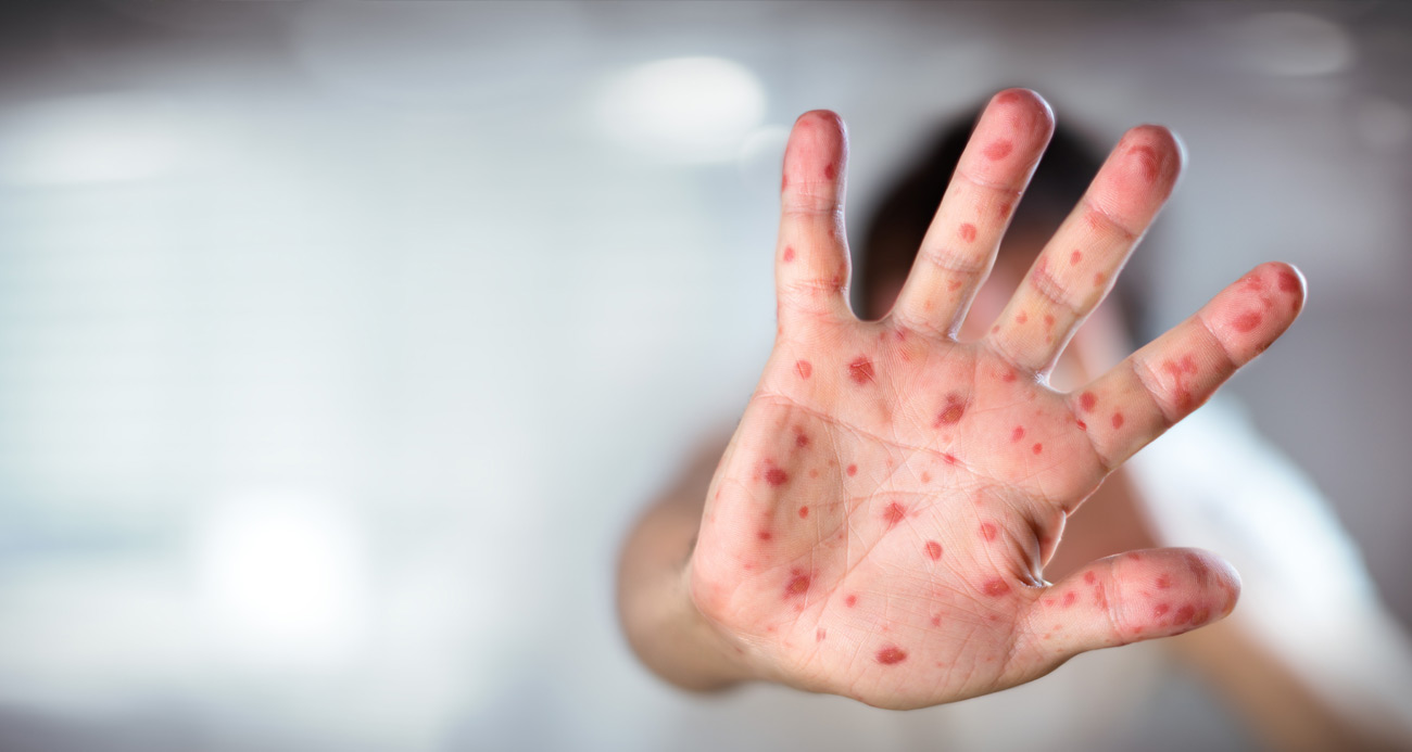 “Kızamık vakalarındaki artışın en önemli sebebi aşı karşıtlığı”