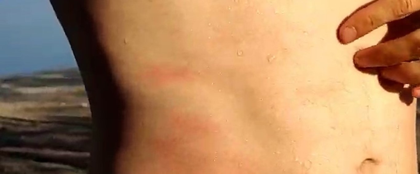 İzmir Foça’da denizanası istilasının ardından vakalar arttı