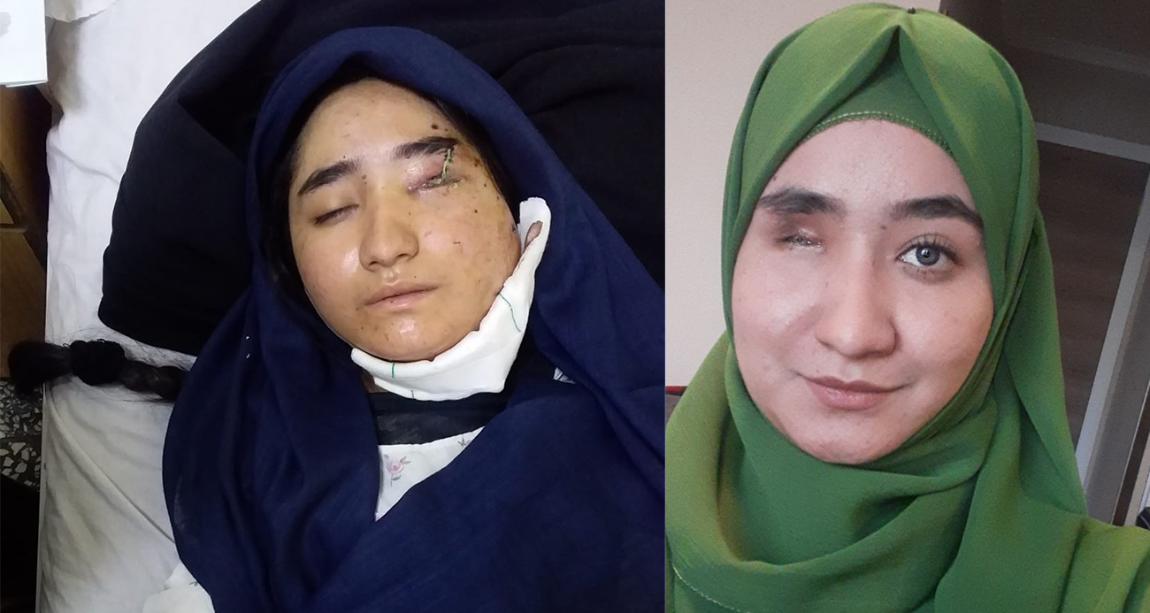 Taliban’ın bombalı saldırısından yaralı kurtulan Fatima dünyaya seslendi