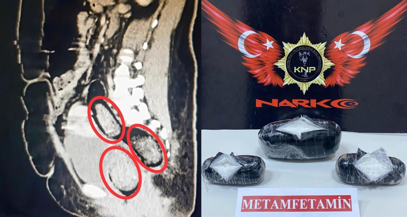 İranlı kadının bağırsaklarından uyuşturucu çıktı