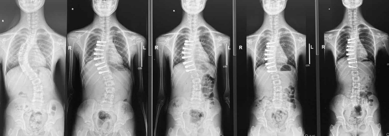 Uzman isim, skolyoz hastası çocuklar için umut olan tedaviyi anlattı