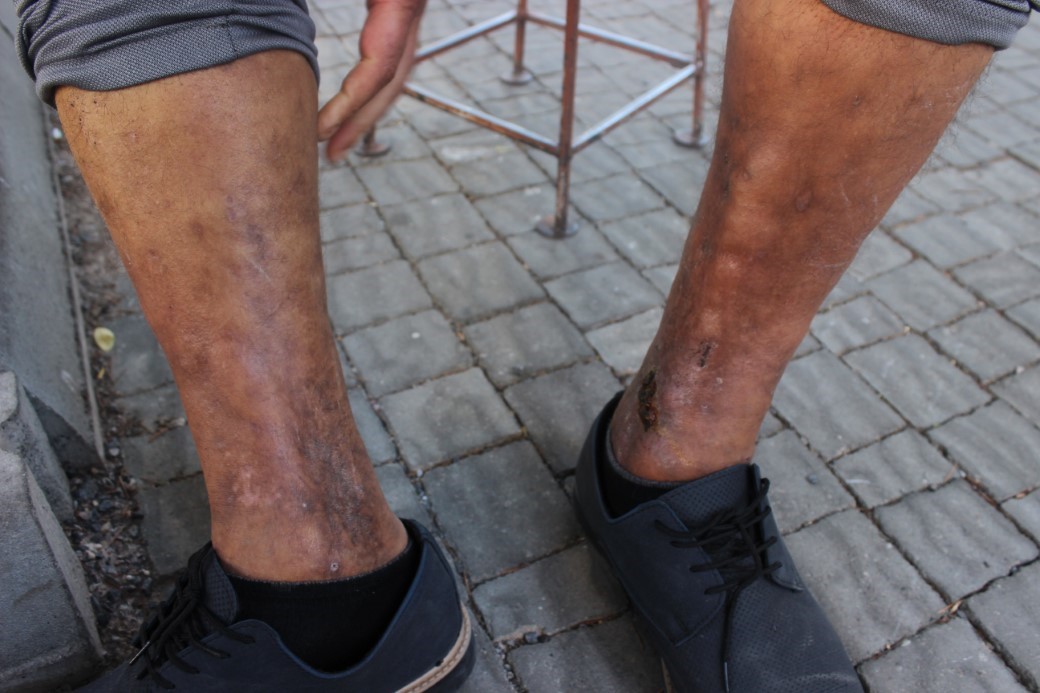 Yanlış sülük tedavisi hayatını kararttı