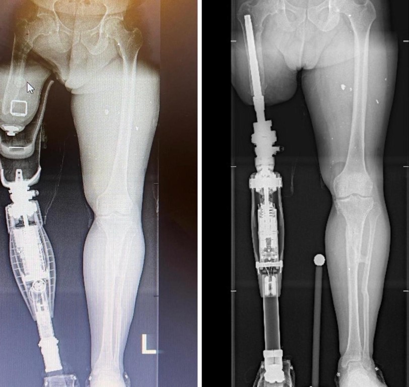 Türkiye’de ilk kez uygulanan son jenerasyon osseointegrasyon protezi ile hayata tutundu