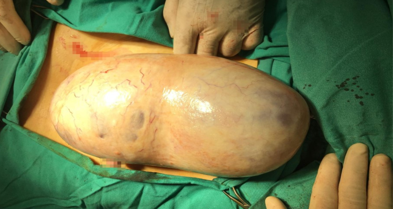 Hamile kadının karnından 2,2 kiloluk kitle çıkarıldı, cenin ve anne kurtuldu