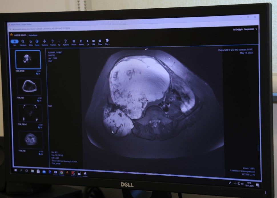 ’Ya ölürsün ya da bacağın kesilir’ dediler, nadir yapılan ameliyatla sağlığına kavuştu