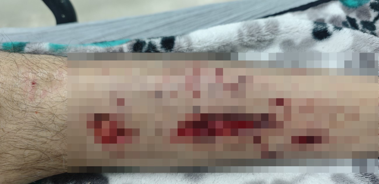 Evinin yolunu karıştıran Alzheimer hastası adam köpeklerin saldırısına uğradı