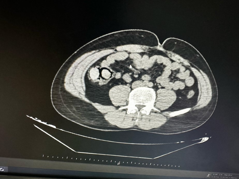 Bu kadarına da pes: Midelerinden 10 parça halinde uyuşturucu çıktı