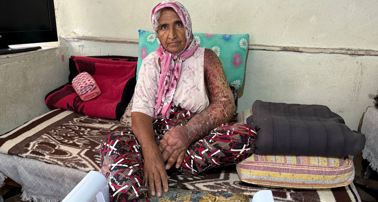 Kolu şişti, vücuduna kadar yara oldu: 4 çocuk annesinin zorlu yaşamı