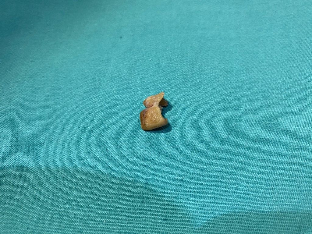 Uykusunda yuttuğu dişler bronşundan çıkarıldı