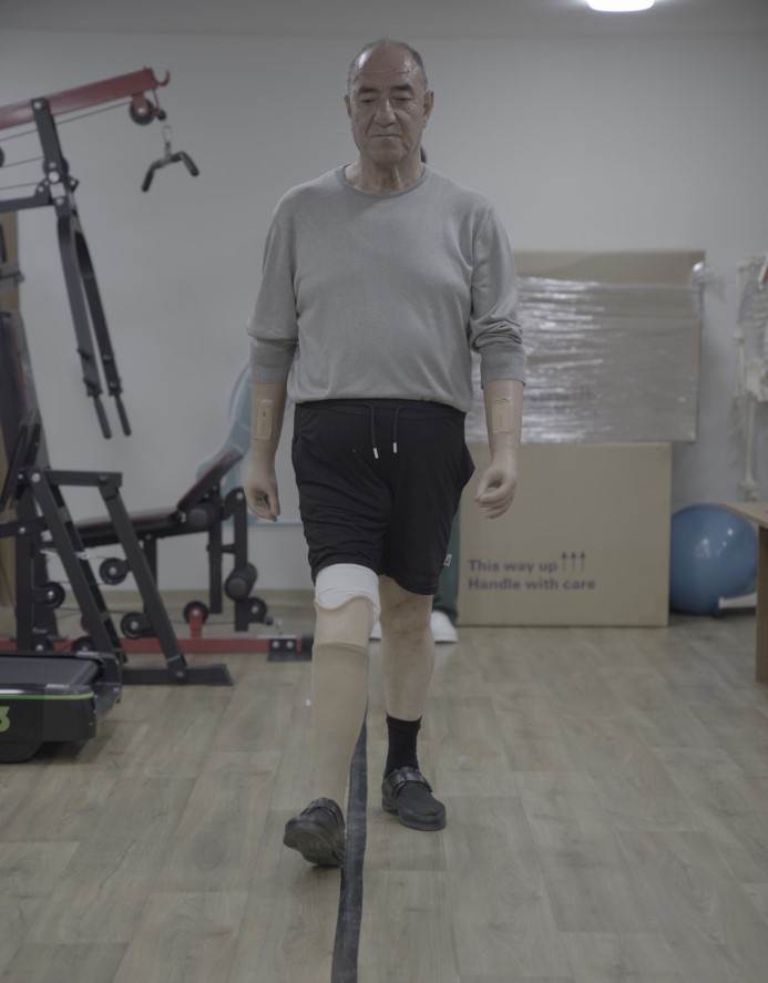 Üç uzvunu kaybetti, protezlerle hayata tutundu