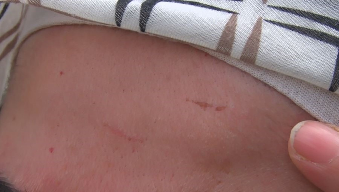 Çamaşırlarının üstüne çöp döktüğü komşusunu önce dövdü sonra darp raporu aldı