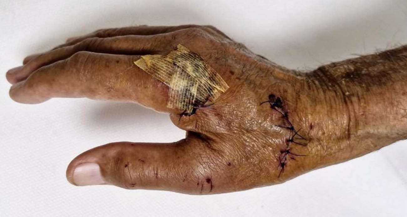 Duşa kabin patladı, eline 20’ye yakın dikiş atıldı