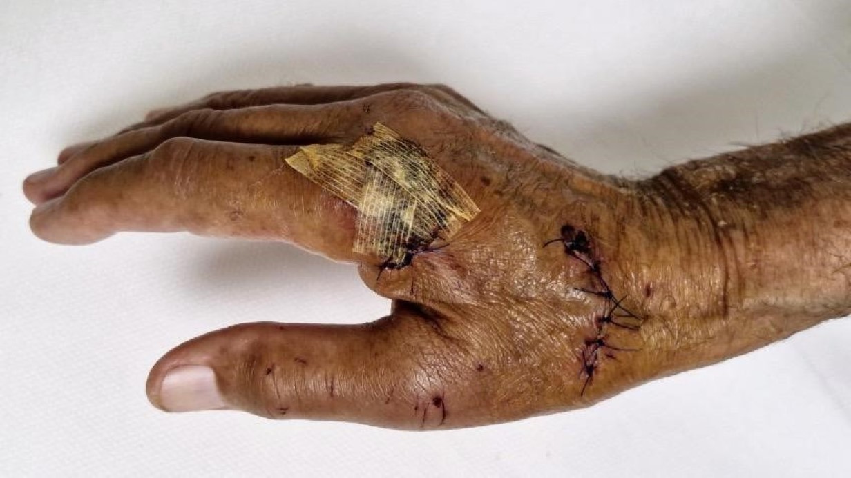 Patlayan duş kabininde yaralandı, 1 aydır direksiyon başına geçemiyor