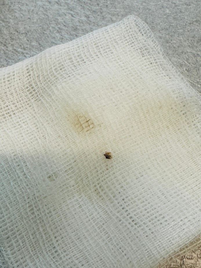 Hastaneye gitti, karnına yapışan kene ile karşılaştı