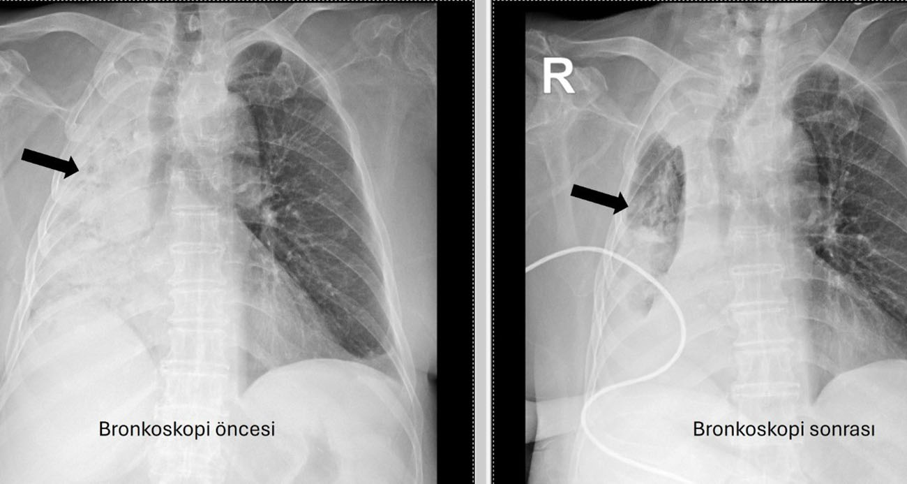 Nefes borusuna kaçan mısır tanesi 5 ay sonra ortaya çıktı