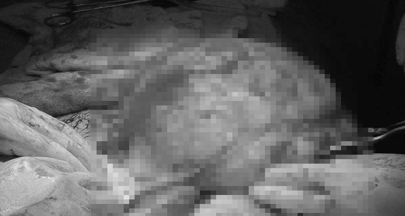 Karın ağrısı şikayetiyle gittiği hastanede karnından 30 santimlik dev kitle çıkarıldı