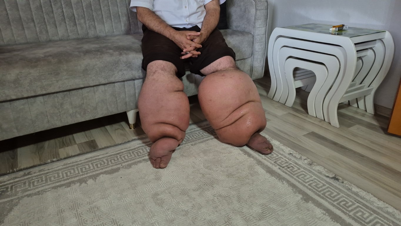 15 yıldır fil hastalığıyla mücadele ediyor