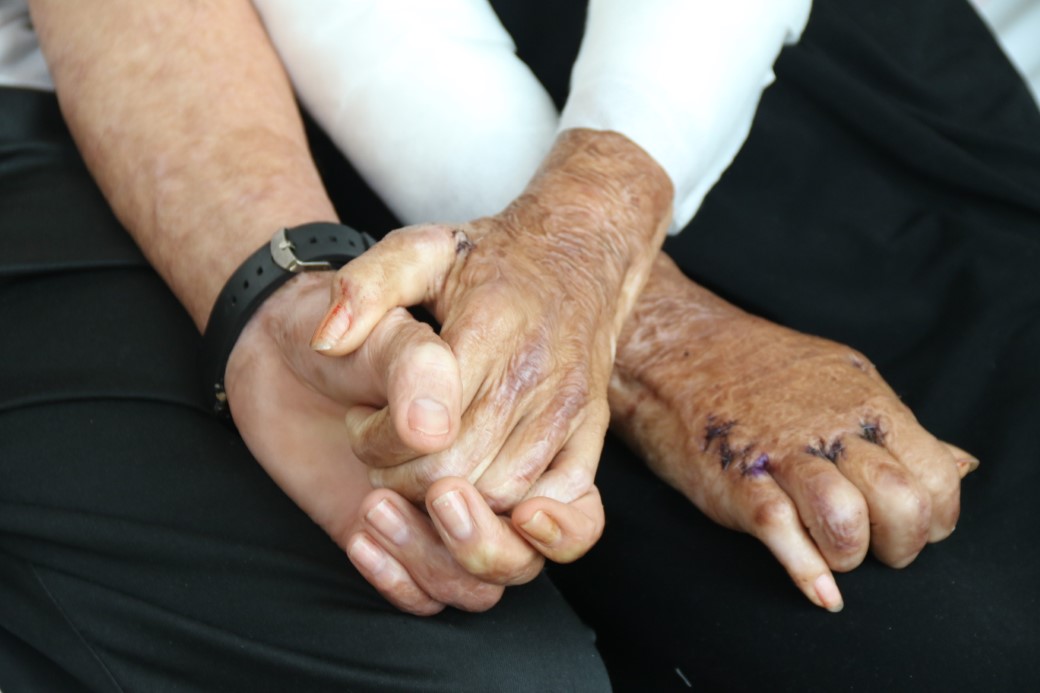 Azerbaycanlı çiftin doğal gaz patlamasında kapanan elleri, 3 yıl sonunda Eskişehir’deki tedaviyle kavuştu