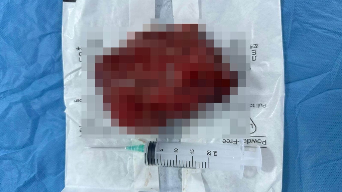 Kalbinin üzerinden 2 kiloluk kitle çıkarıldı