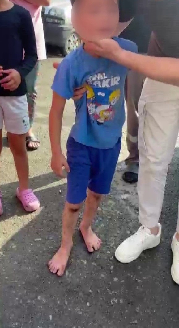 Beykoz’da 6 yaşındaki çocuk başıboş sokak köpeklerinin saldırısına uğradı