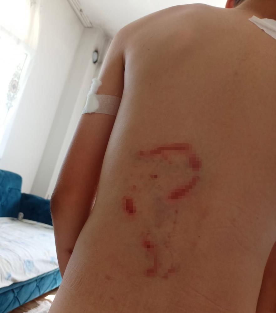 Vücudu köpek tarafından parçalanan Yunus’un kolu kullanılamaz hale geldi, aile adalet arıyor