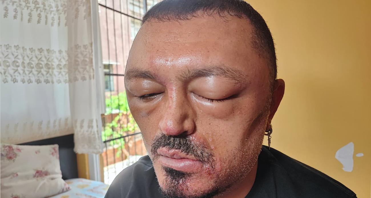 Saçlarını siyahlatmak için aldığı şampuan arı sokmasından beter hale getirdi