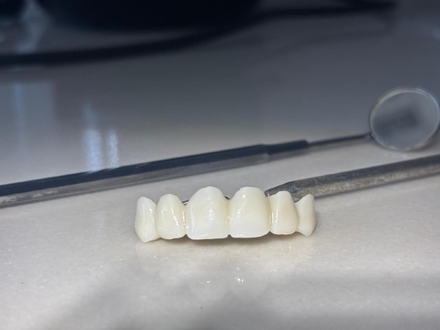 Özelde 8 bin TL olan kaplama, devlet hastanesinde 188 TL’ye yapılmaya başladı