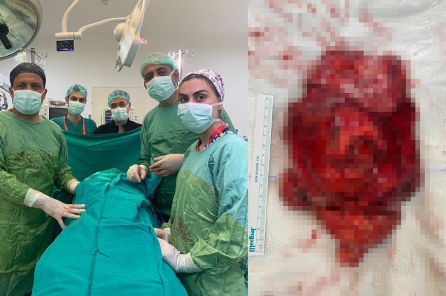 Tıpta ender rastlanan dev tümör ameliyatla çıkarıldı