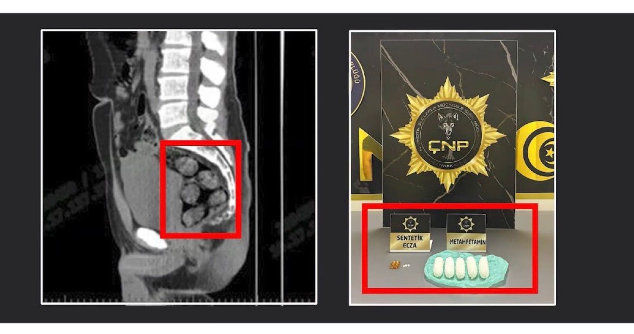 Tomografide şok eden görüntü...Uyuşturucu midesinden çıkarıldı