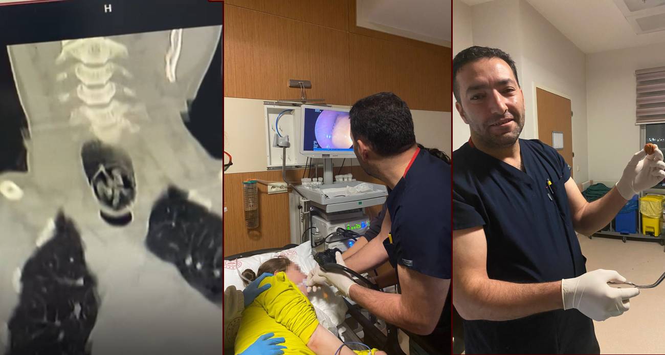 Ağrı’da yuttuğu ceviz yemek borusundan çıkarıldı