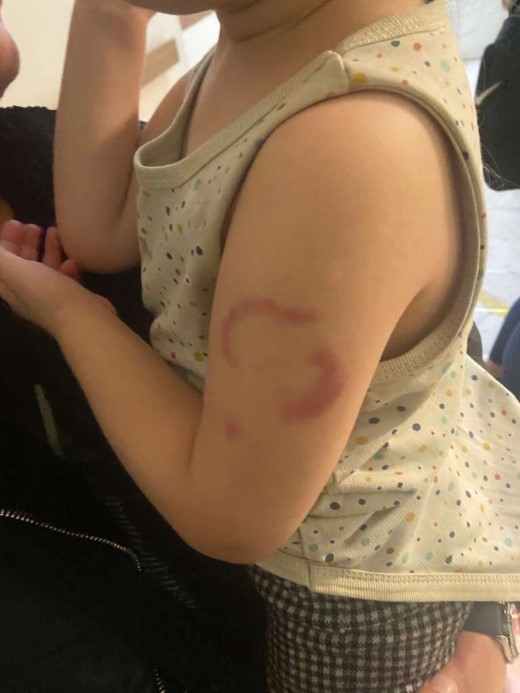 3 yaşındaki çocuğa felaketi yaşattı: İddiaya göre öğretmen çocuğun kolunu ısırdı