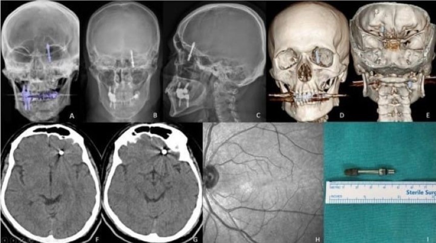 Beynine saplanan implant hayatını kararttı: 2 yıldır adalet bekliyor