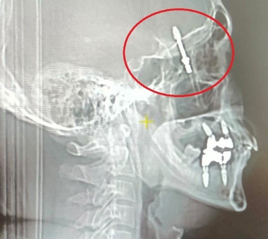 Beynine saplanan implant hayatını kararttı: 2 yıldır adalet bekliyor