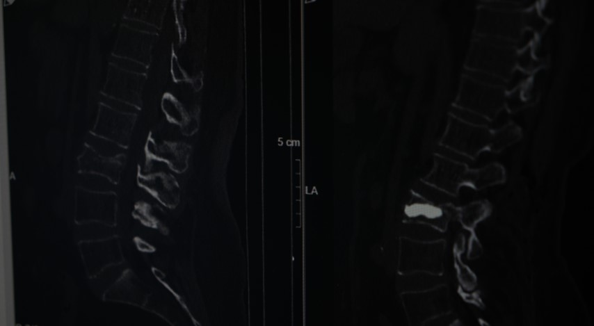 Kemik erimesine dikkat: 76 yaşındaki hasta, omurga kırığı ağrılarını fıtığa bağladı