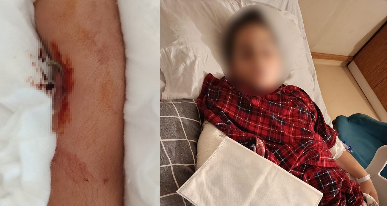 Büyükçekmece’de akran zorbalığı, arkadaşının kolunu 2 yerden kırdı