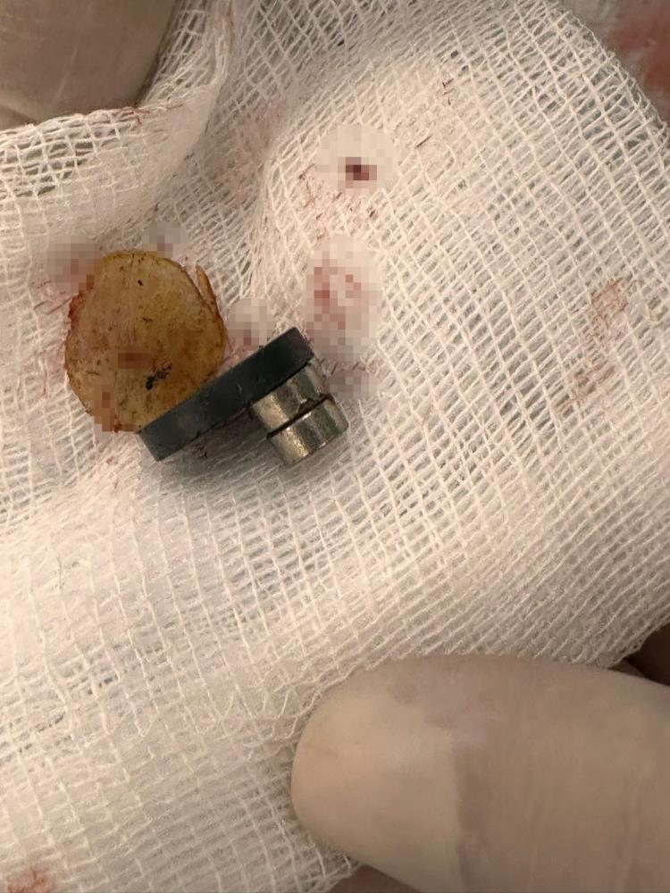 Bebeğin yuttuğu mıknatıslar bağırsak delinmesine neden oldu