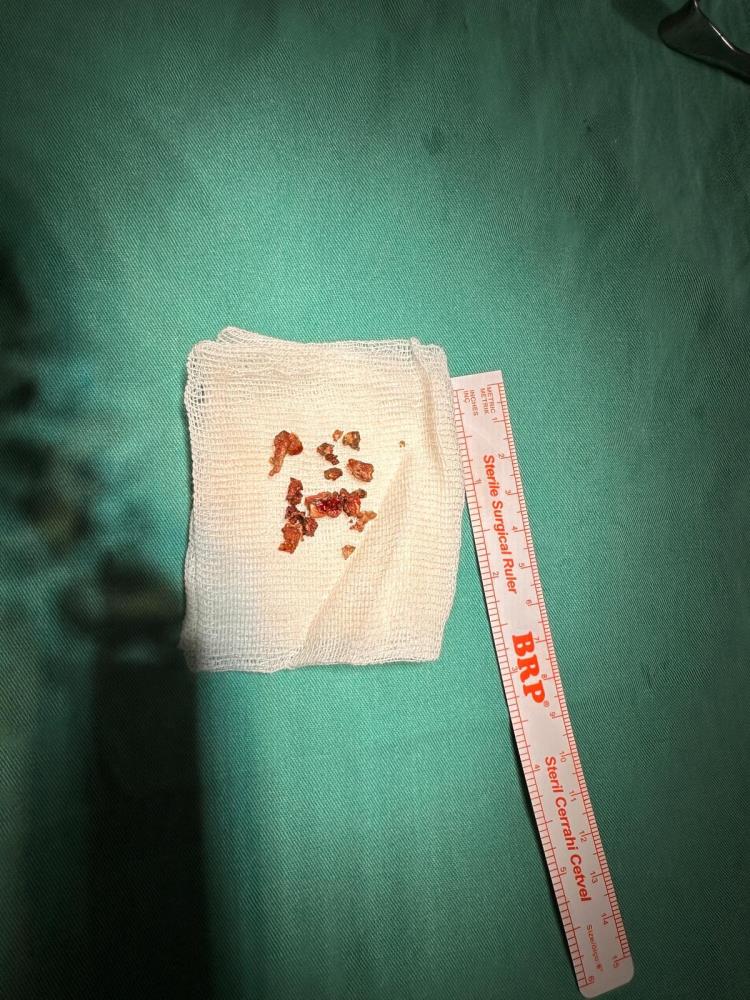 Elazığ’da estetik ameliyatta şaşırtan olay, burundan taş çıktı