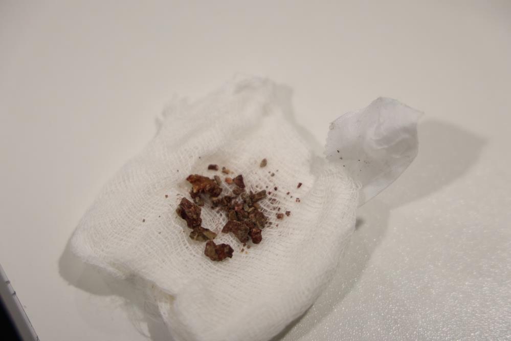 Elazığ’da estetik ameliyatta şaşırtan olay, burundan taş çıktı