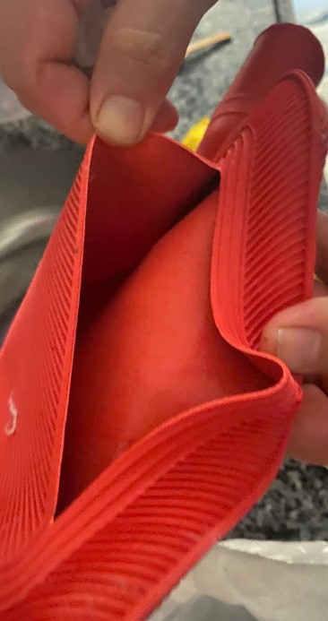 Sıcak su torbası patladı, genç kızın vücudunun yüzde 25’i yandı: 