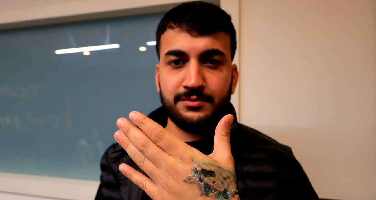 Dövme sildirmek isterken kabusu yaşadı, elindeki dokular öldü