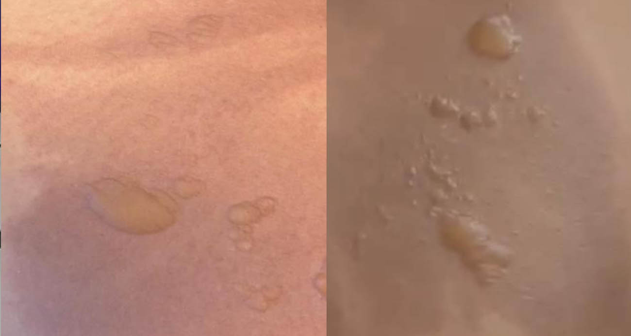 Yine sıcak su torbası yine facia: "Koyduktan 3 dakika sonra patladı" - SAĞLIK