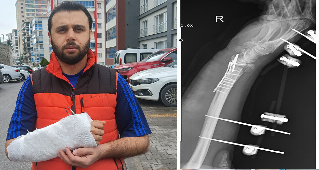 Sahipsiz köpeklerin saldırısından kaçmak isterken bileği kırıldı