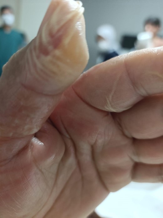 Sıcak su torbasının patlamasıyla vücudunun yüzde 30’u yandı: 