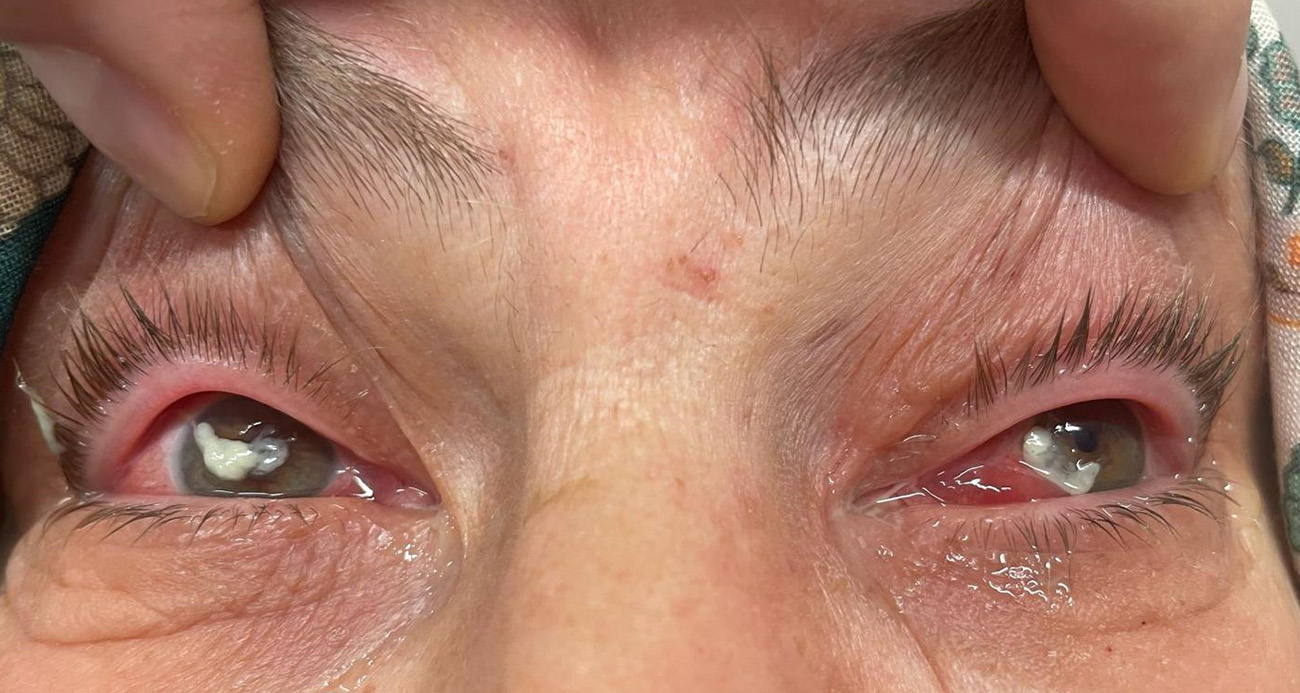 Kocaeli’nde yaşayan 52 yaşında kadın, iddiaya göre uzağı göremediği için kullandığı gözlükten kurtulmak için gözlerine kırlangıç otunun suyunu damlatınca göremez hale geldi. Hastasına ilişkin konuşan Göz Hastalıkları Uzmanı Doç. Dr. Ömer Faruk Yılmaz, "Gözlükten kurtulmak için kırlangıç otu suyunu damlattı, göremez hale geldi. Gözlerini açamaz haldeydi, ‘Acaba göremeyecek miyim?’ diyordu, 2 gözün de korneasının tamamen tahrip olduğunu gördük. Tedavi sonucunda tamamen iyileşti. Sosyal medyada özellikle son zamanlarda kırlangıç otu çok yaygınlaşmaya başladı. Faydalı bile olsa Sağlık Bakanlığı ruhsat vermeden, ilaç formatına dönüştürmeden, uygun doz ayarlanmadan ve göz hekiminin önerisi olmadan herhangi bir bitkisel ilaç önermiyoruz" dedi.