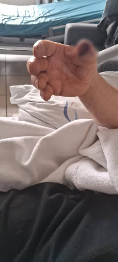 Başıboş köpeklerin saldırısına uğrayan adamın baş parmağı koptu