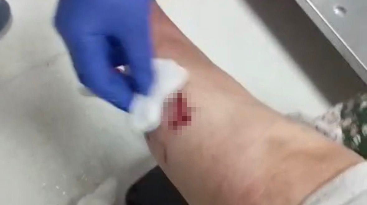 Nizip’te başıboş köpek saldırısında yaralanan 2 kişi belediyeye tepki gösterdi