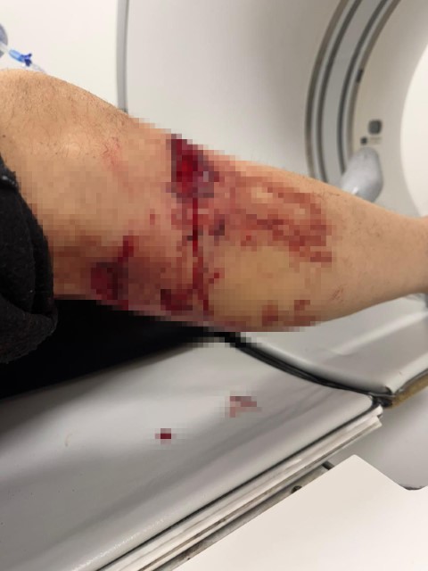 Nizip’te başıboş köpek saldırısında yaralanan 2 kişi belediyeye tepki gösterdi