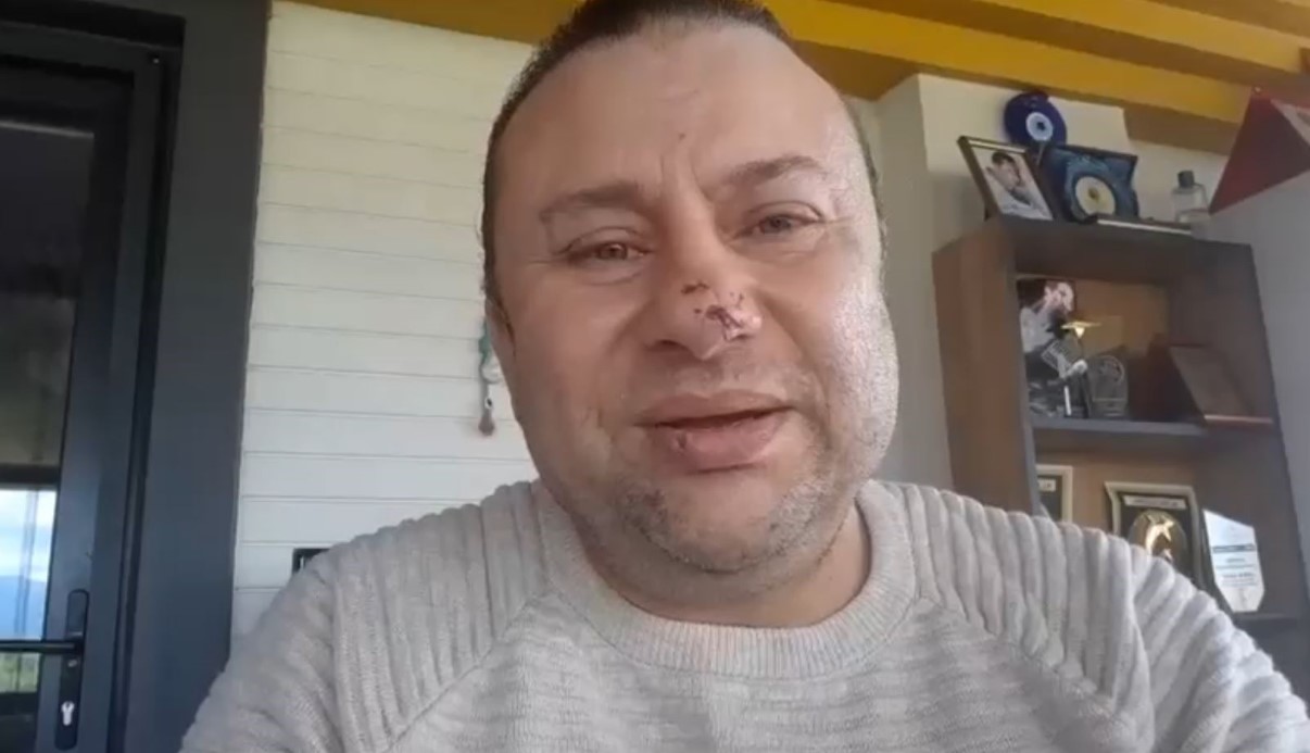 Pitbull saldırısına uğrayan Onur Akay o anları anlattı: "Ölümden döndüm"