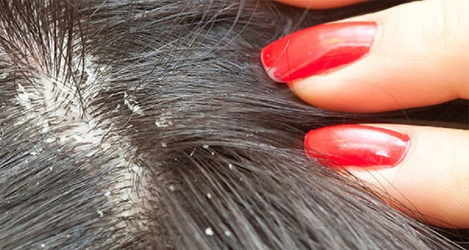 Kadınlarda saç dökülmesine dikkat